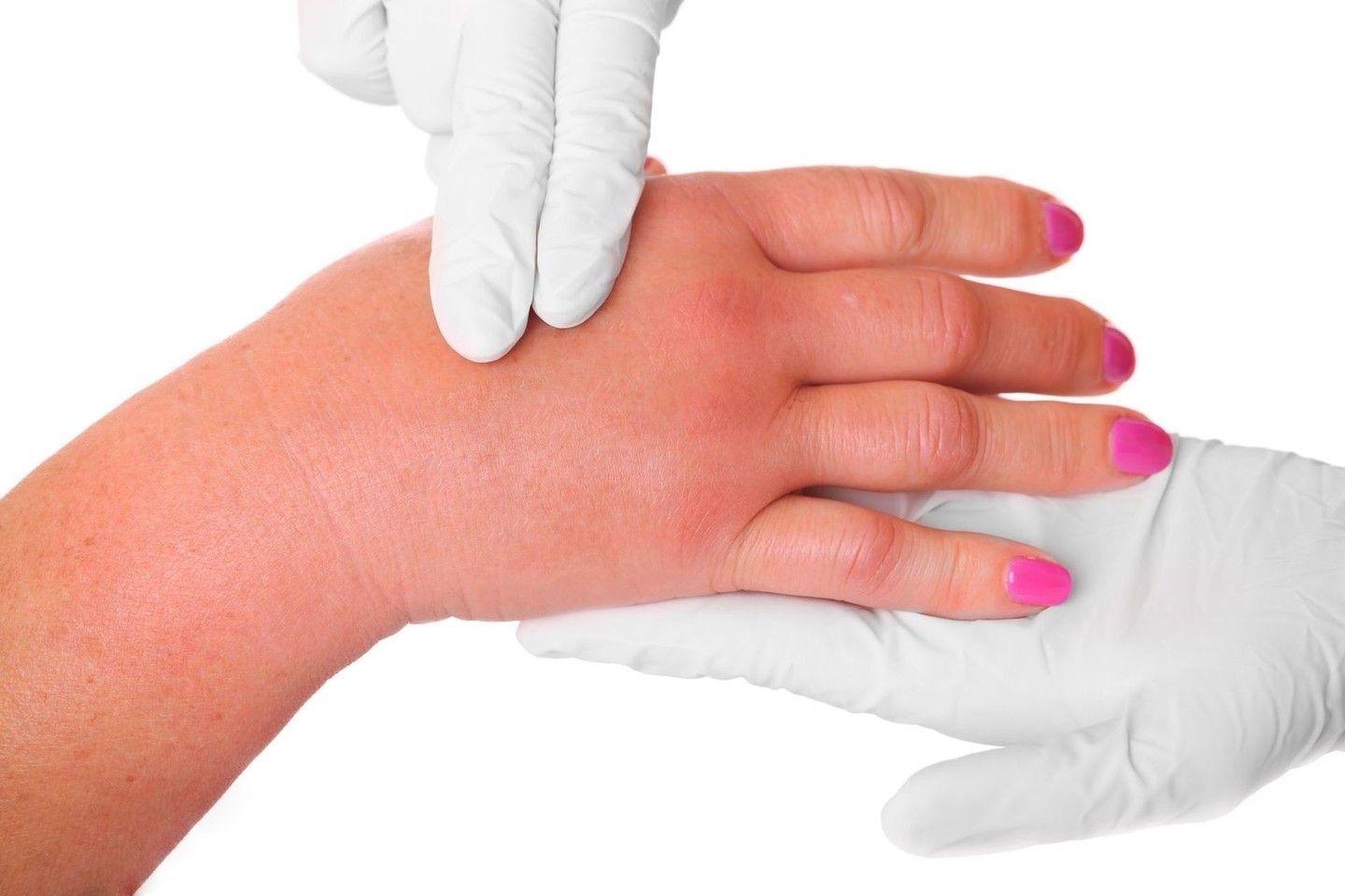 artritas rankos pirštų tabletės nuo skausmo sąnariuose sąraše