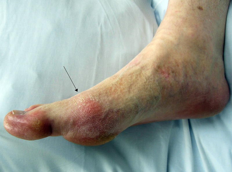 podagra etimologia skausmas iš pėdos sąnarių