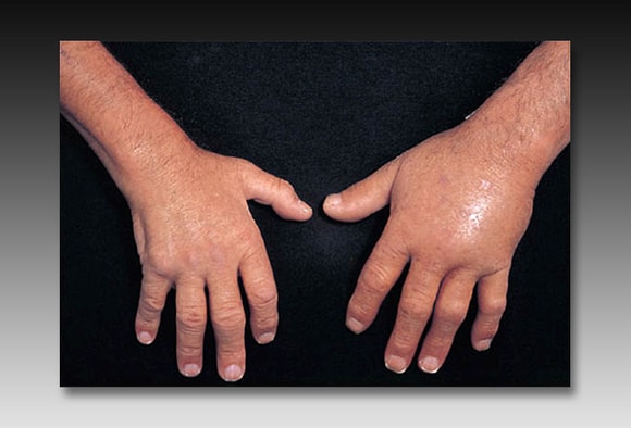 aštrus skausmas liaudies metodai gydant artrito rankas