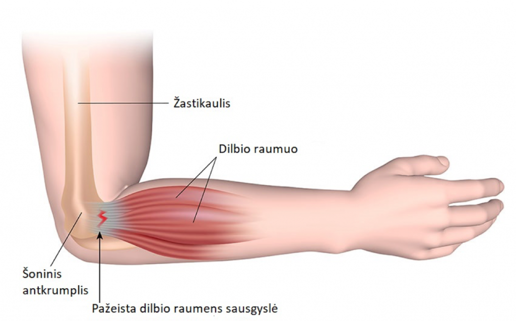 epipudilite liga alkūnės sąnario skauda rankos venas
