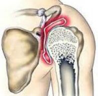 joint edema osteoarthritis kiek laiko gyja padikaulio lūžis