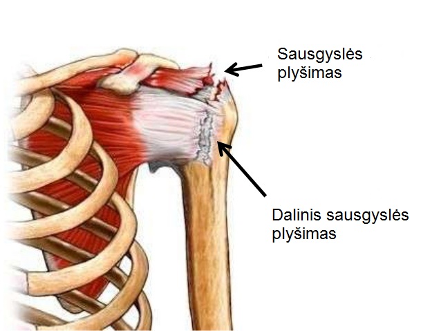 sąnariai ir raumenys gydymas nugaros skausmas pereinantis i desine koja