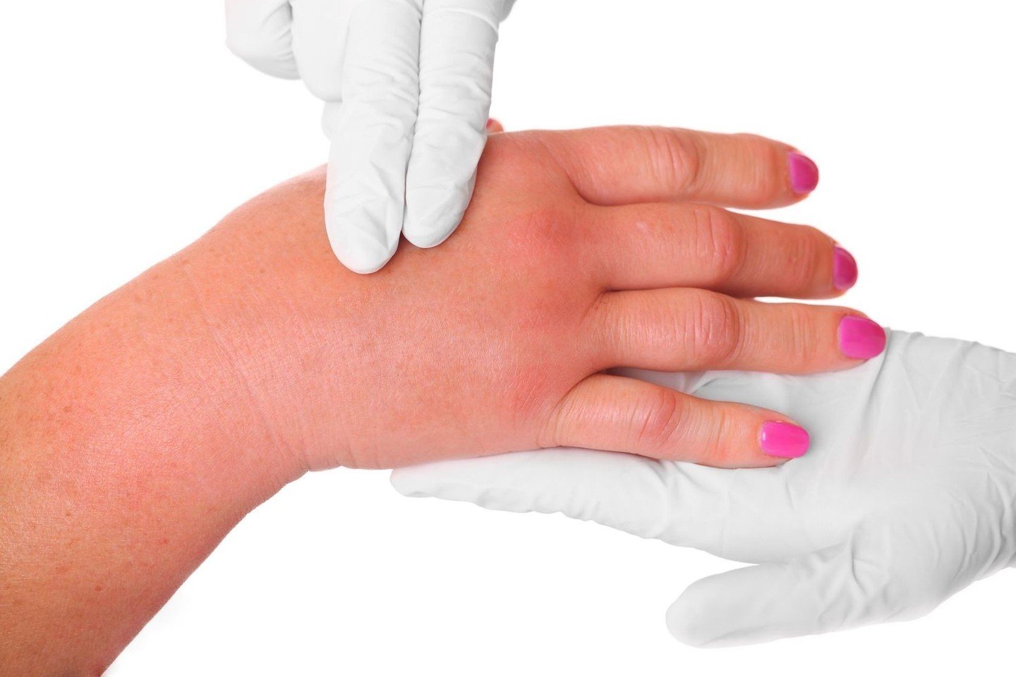 pasiskirstymas sąnarių artrozės šykštuolis sąnarius skauda ranka