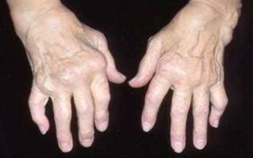 artritas nykščio ant rankų