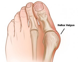 ūminis artritas ir pėdos nykščio kur yra
