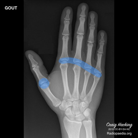 podagra arthritis radiology