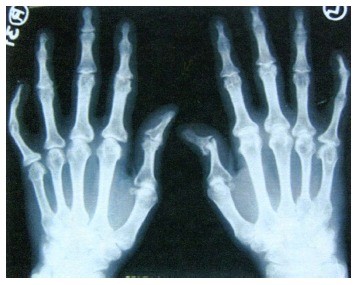 rankos pirstu skausmas tepalas gyvenimo ne osteochondrozės
