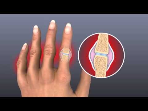 swollen painful joints in hands rankiniai skausmai pečių