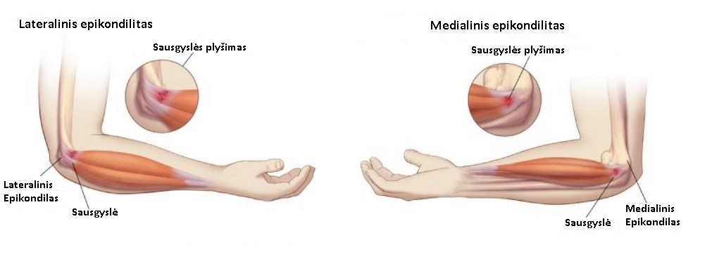 rankos rieso sausgysliu uzdegimas ant rankos piršto skauda sąnarį ir spustelėkite