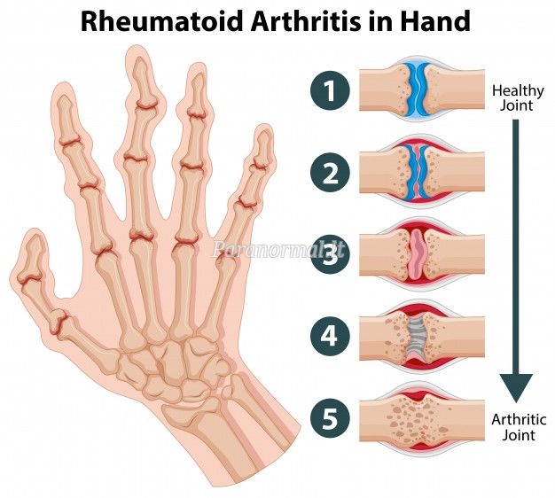 reumatoidinis artritas rankų gydymo liaudies gynimo priemones sunkus skausmas peties sąnario pašalinti