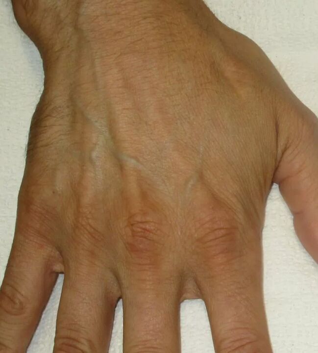 vaistažolės sąnarių gydymo artritas ar artrozė sustav