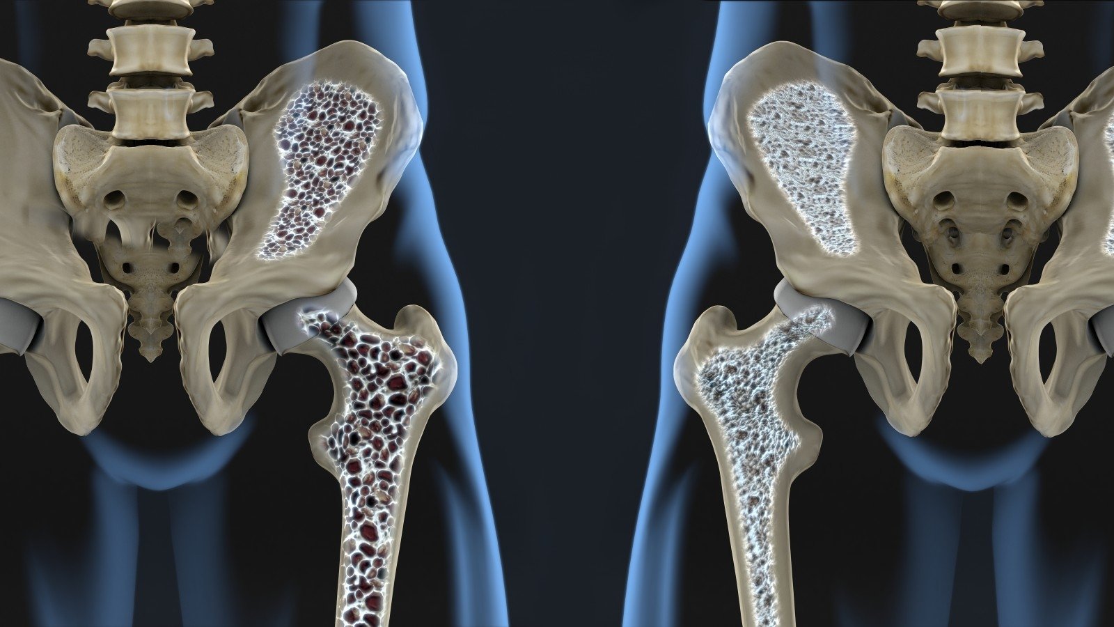 gydymas osteoprozoz sąnarių ligos sąnarių ir raiščių prevencijos
