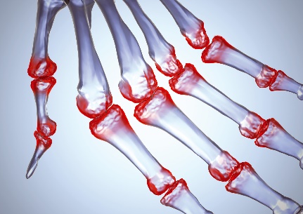 badavimo su osteoartritu rankas sąnarių