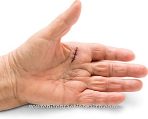 pašalinti pirštų finger uždegimas kaip padėti kai bendras skauda