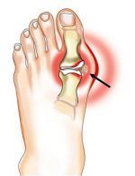 kojos sanario skausmas