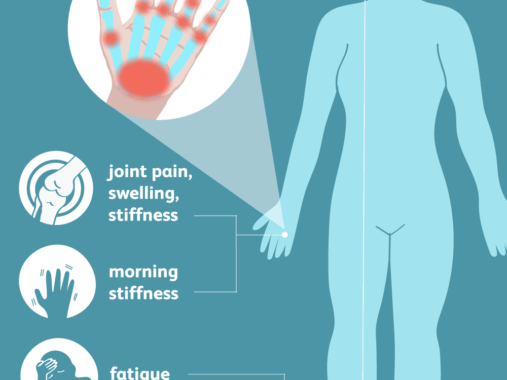 joint edema osteoarthritis artrozės rankų valymo atsiliepimai