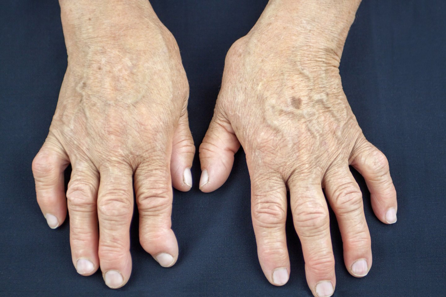 reumatoidinis artritas simptomai kaip sumažinti uždegimą osteoartritu peties sąnario
