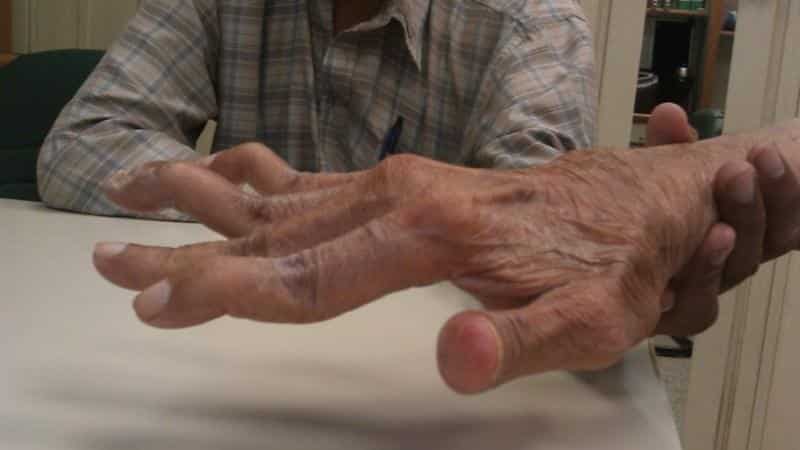 pradiniai artritas pirštai