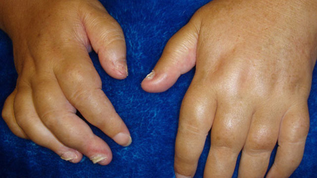 swollen painful joints in hands radiologinis gydymas artrozės