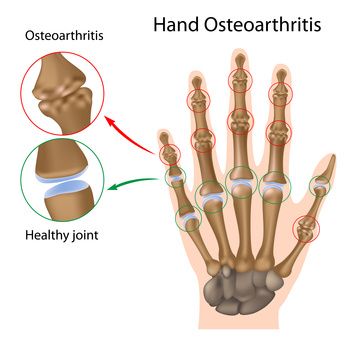 tradiciniai metodai gydant osteoartritą iš rankų kaip padaryti kad tepalas sąnarių