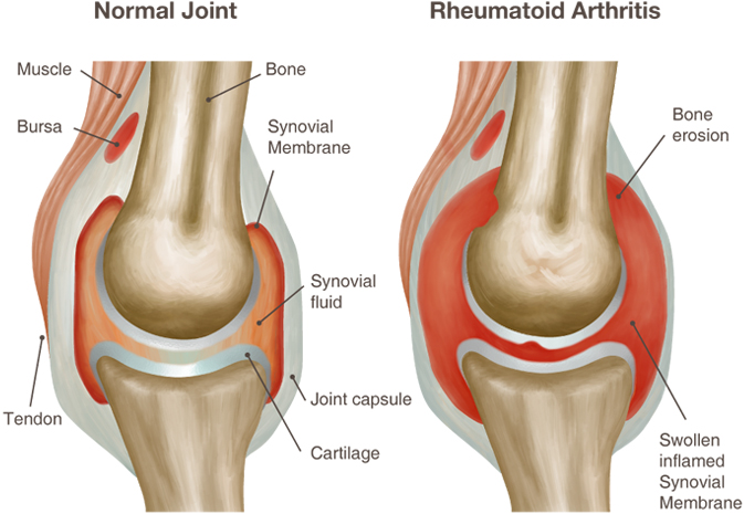 artritas sąnarių gydymo apžvalgų