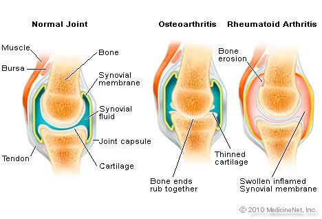 swelling in joints causes šaltalankių aliejus iš sąnarių uždegimu