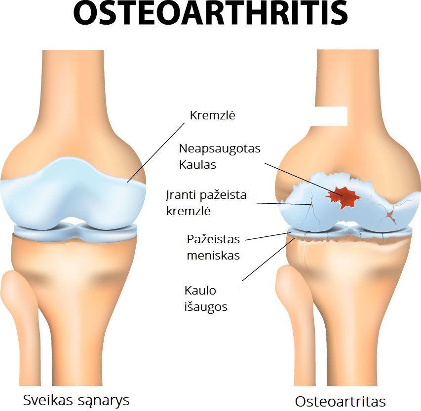 su kuria infekcija sąnariai ir raumenys skauda artritas iš alkūnės sąnario gydymo