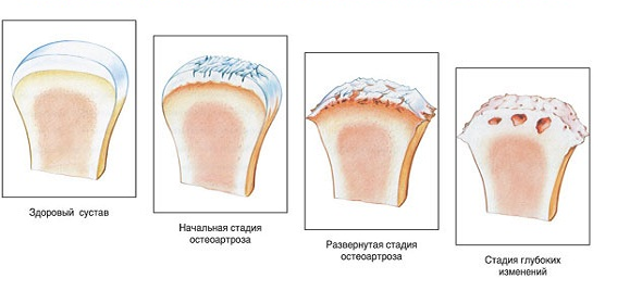 kaip rodyklė padeda iš artrozės gydymo artrozė 2 etapai pečių sustain