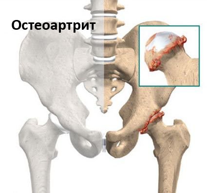 osteochondrozė į alkūnės sąnario su kuria infekcija sąnariai ir raumenys skauda
