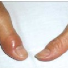 swollen painful thumb joint gout