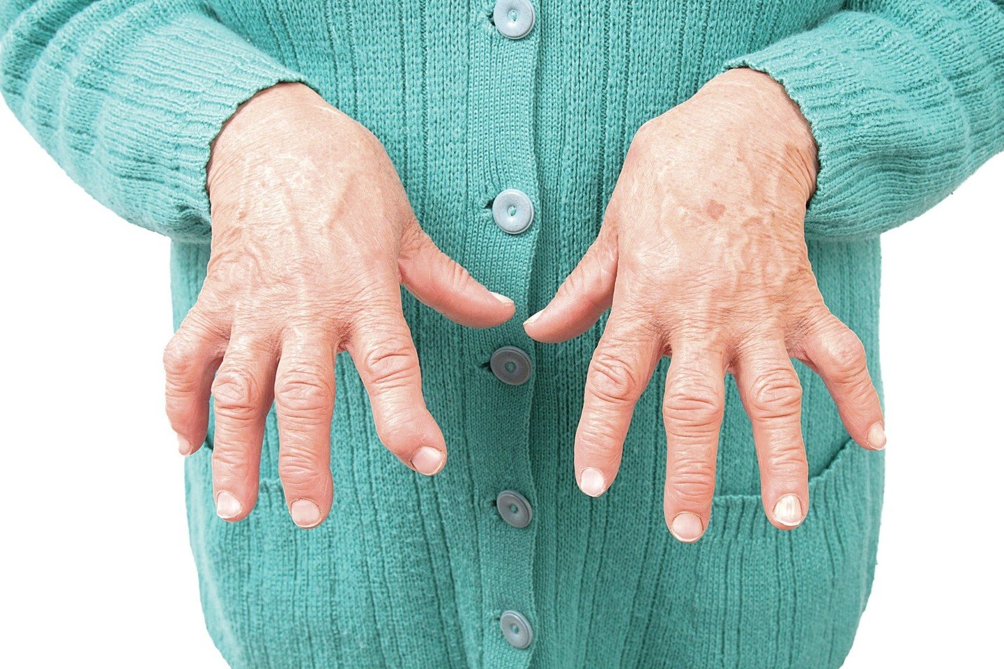 kaip padaryti rankos skauda artritas