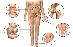 artritas ir poliartritas ant piršto periferinis nervo galas