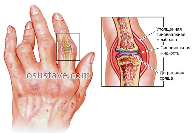 gydymas su sąnarių reumatizmu spondilozi artrozė arc-priversti sąnarių
