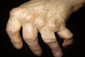 artritas nykščio ant rankų gydymui