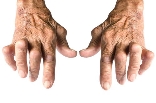 ką artritas rankos atrodys