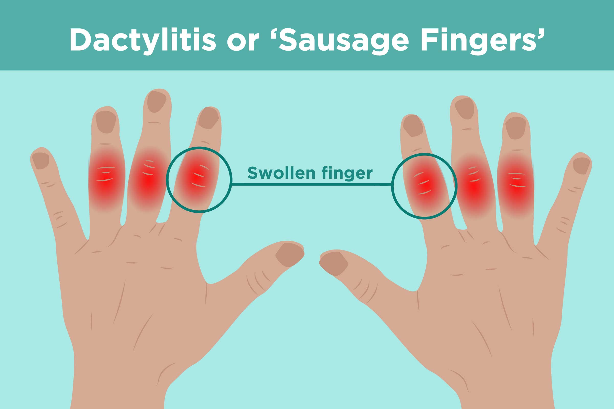 swollen painful joints in hands swelling in finger joints during pregnancy