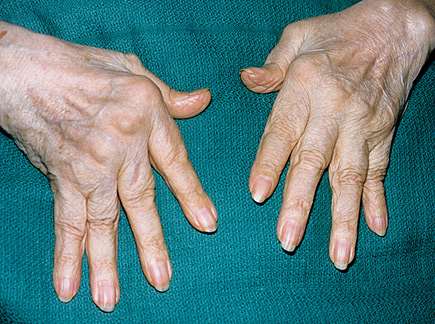 reumatoidinio artrito tyrimas milt f 5 o1 gydymas sąnariams