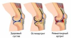 kas yra artrozė kojų valymo liaudies gynimo atsiliepimai