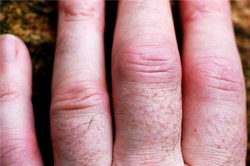 artritas piršto rankos gydymas mazi skausmas bemps ir sąnarių