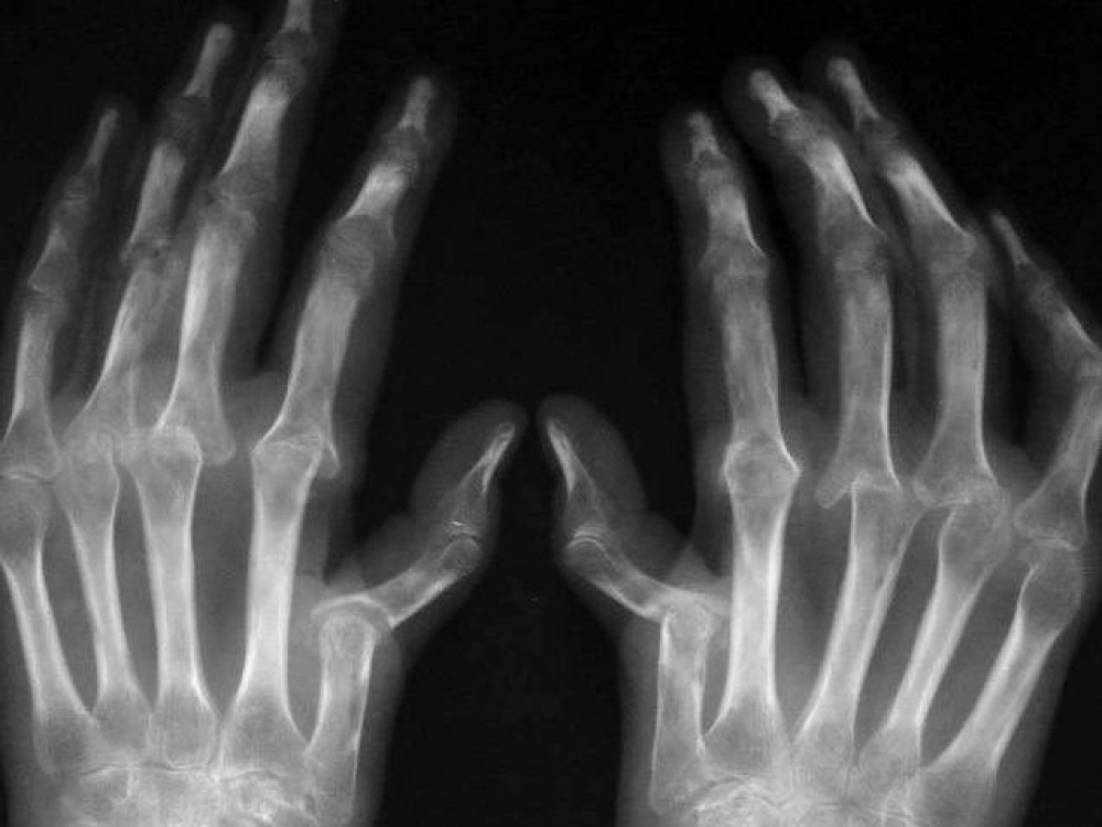 artrosis trečiojo laipsnio gydymas reumatoidinis artritas sąnarių atskirties