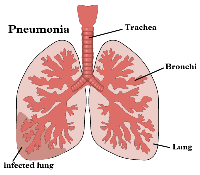 komplikacijos plaučių uždegimas sąnariams