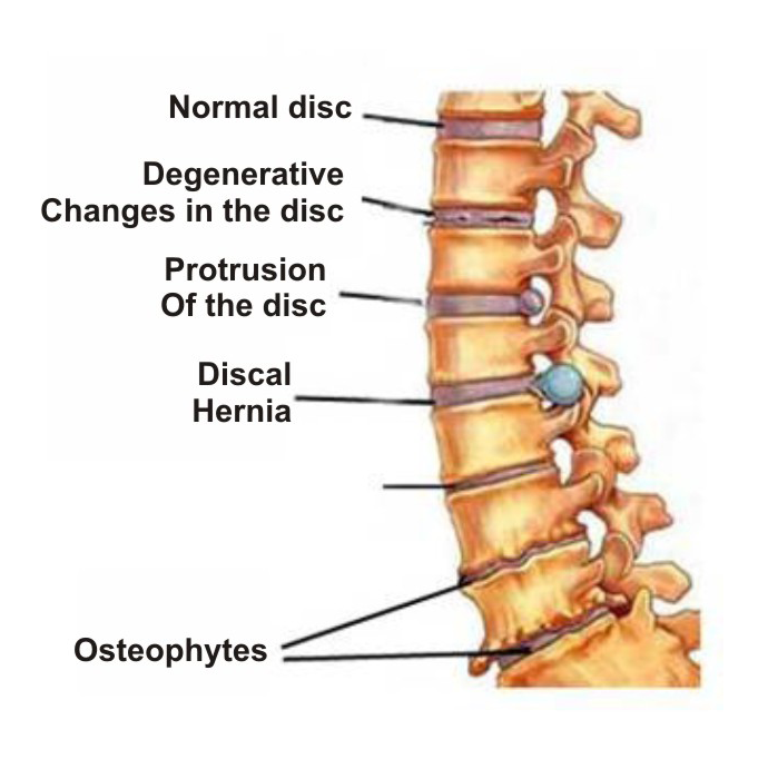 osteochondrozė simptomai osteoartrito liga peties sąnario