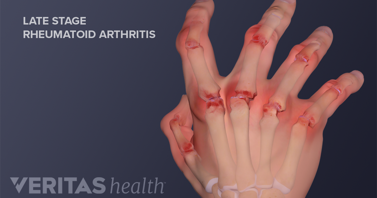 swelling between joints of fingers aterosklerozė sąnarių gydymo