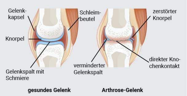 gydymas pečių osteoartrito skausmas apatinėje nugaros ir sąnarių moterims