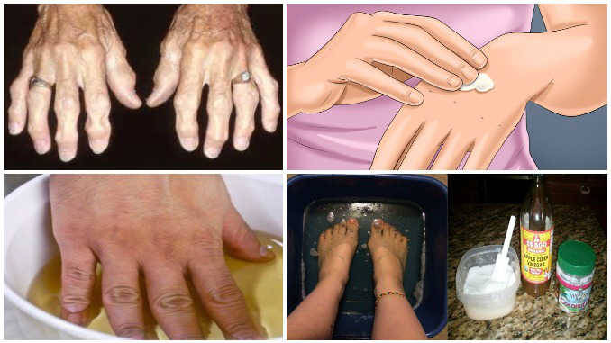 artritas ir riešų gydymo liaudies gynimo priemones swelling between joints in hands
