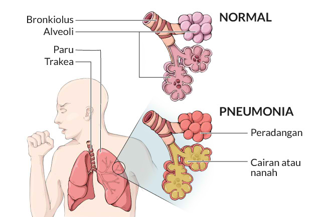 pneumonija skausmas sąnarių ir smegenų patinimas