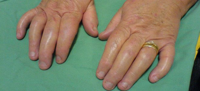 liaudies gynimo priemonės nuo artrito pirštais