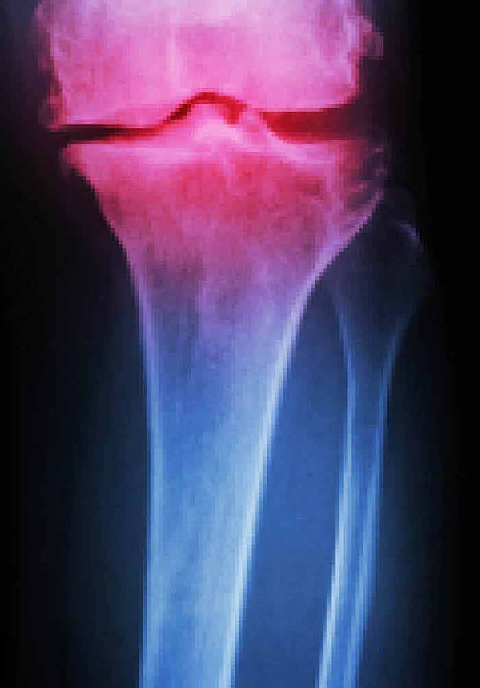sustaines artrozės paklaida sprogdinimo peties sąnarių gydymas