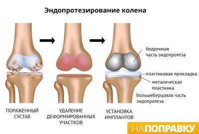 gydymas osteoartrozės pėdos sąnarių liaudies gynimo priemones