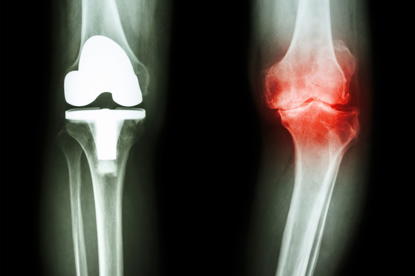 pranešimo grynas artritas rankų gydymas gydymo salierai į artrozės gydymo